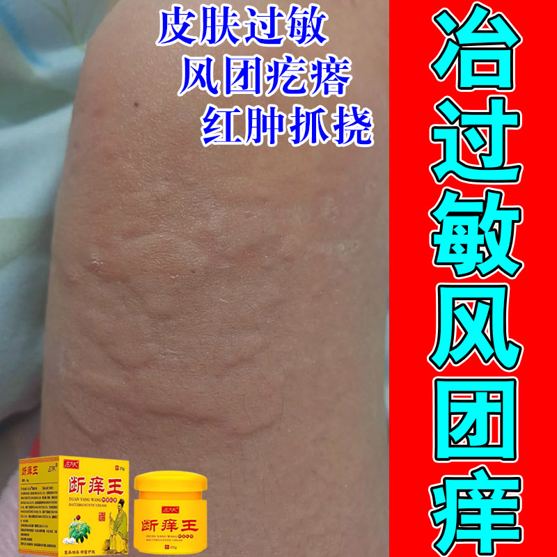 风团疙瘩皮肤抓挠红肿刺挠划痕手臂身上大片起疙瘩发痒软膏