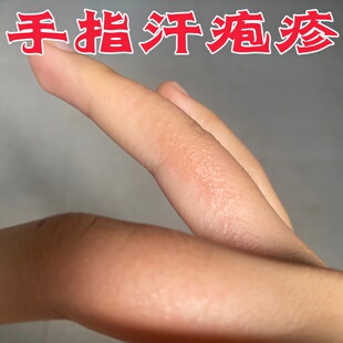 手指疱汗状疹手上起水泡痒药止汉状真菌手掌湿痒疹脱皮手气外用膏