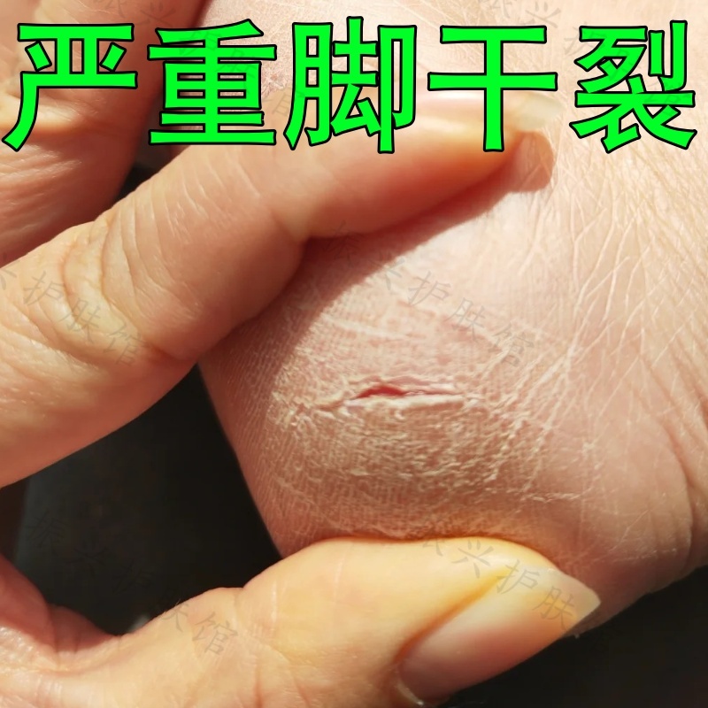 脚后跟干裂真菌感染药足跟开裂起硬皮修复霜角化脚痒脱皮去死皮膏