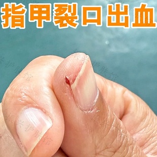 指甲缝手裂口专用手指尖开裂疼痛手开裂修复防干裂粗糙角质增厚药