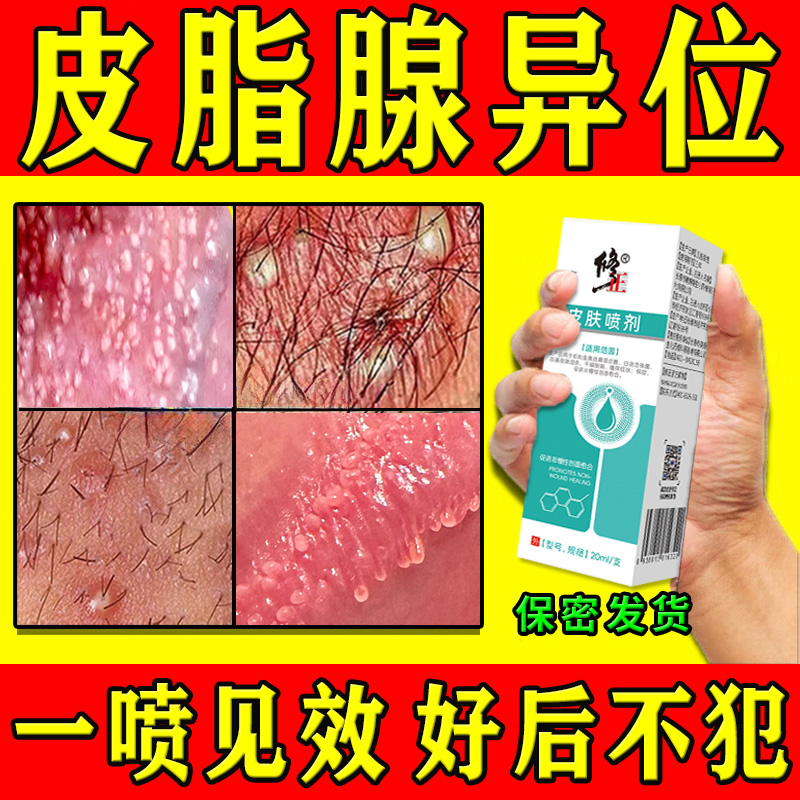 皮脂腺异位症男人阴囊阴茎小疙瘩脂肪粒潮湿瘙痒珍珠丘疹效特专用