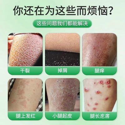 皮肤干燥瘙痒止痒膏非药冬天季腿痒小腿干燥起皮痒掉皮屑软膏