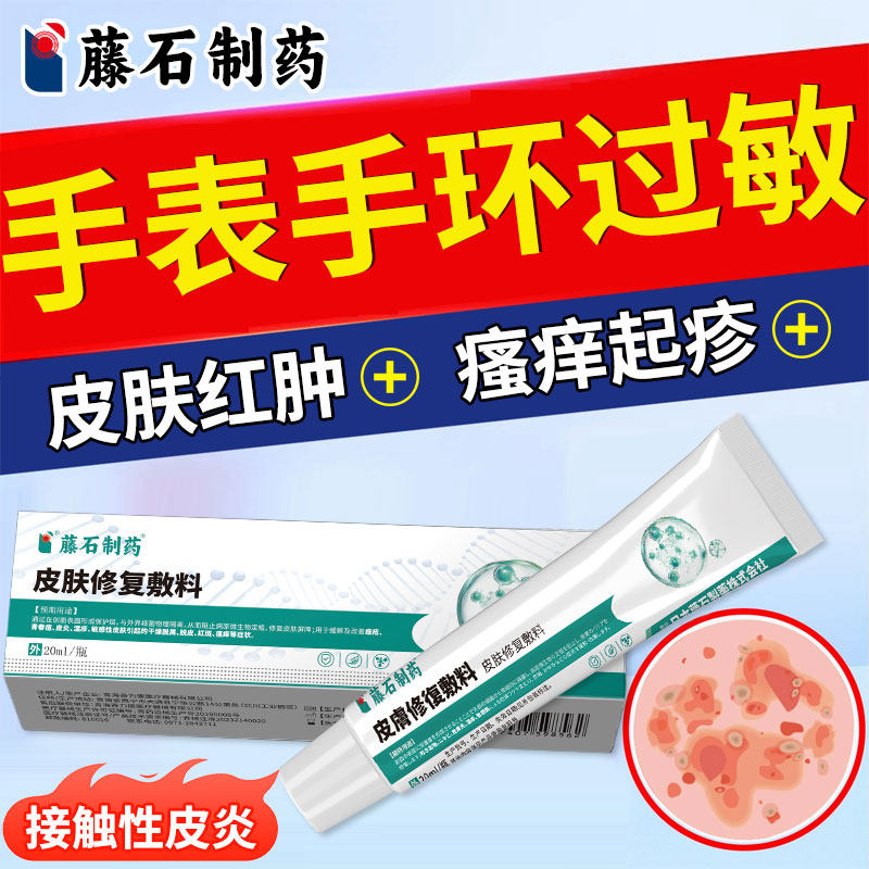 带手表手环过敏接触性皮炎红肿瘙痒起疹子金属过敏药监备案膏AH
