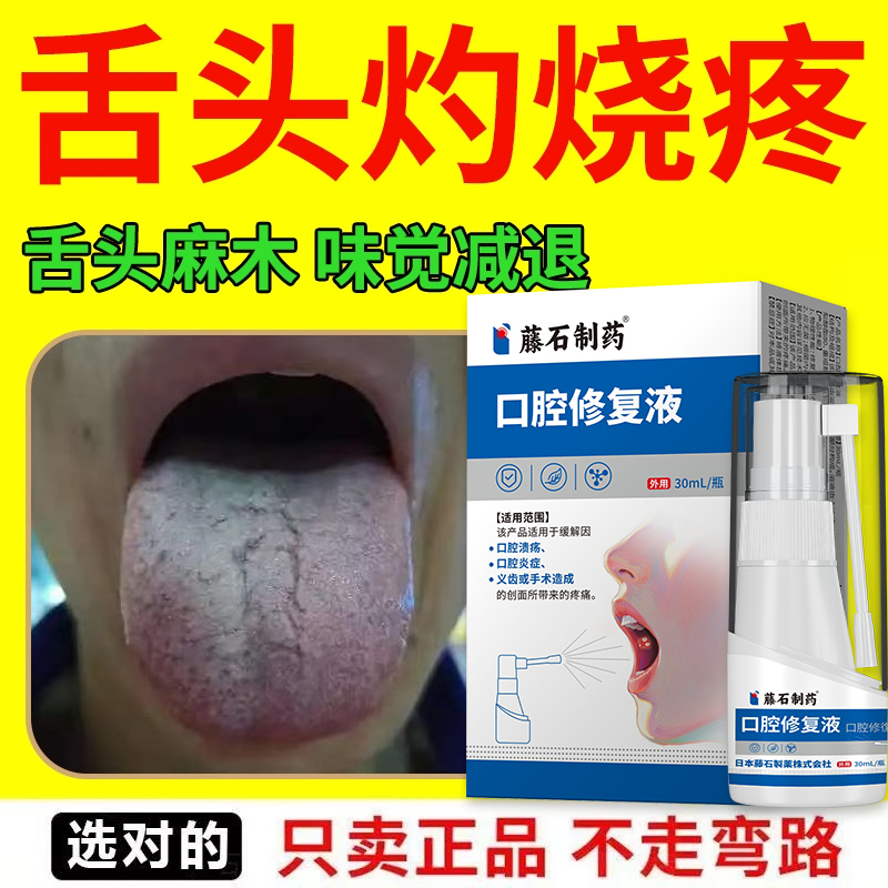 灼口综合症中老年舌头灼烧疼火辣