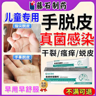 儿童真菌感染手指尖手掌脱皮干燥瘙痒用专修护凝胶药房同售YK