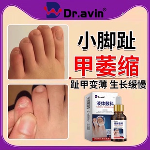 小脚趾甲萎缩短小趾甲变薄生长缓慢灰指甲增厚变色凝胶甲沟炎AH