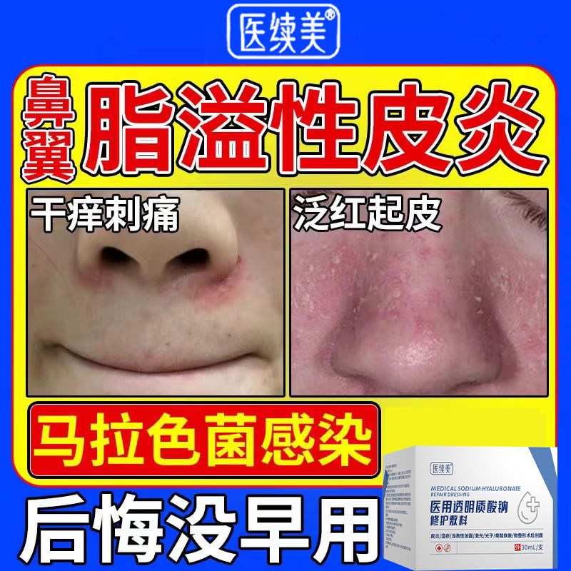 鼻翼脂溢性皮炎鼻子两侧发红脱皮马拉色菌脸部干痒刺痛皮肤敷料YK