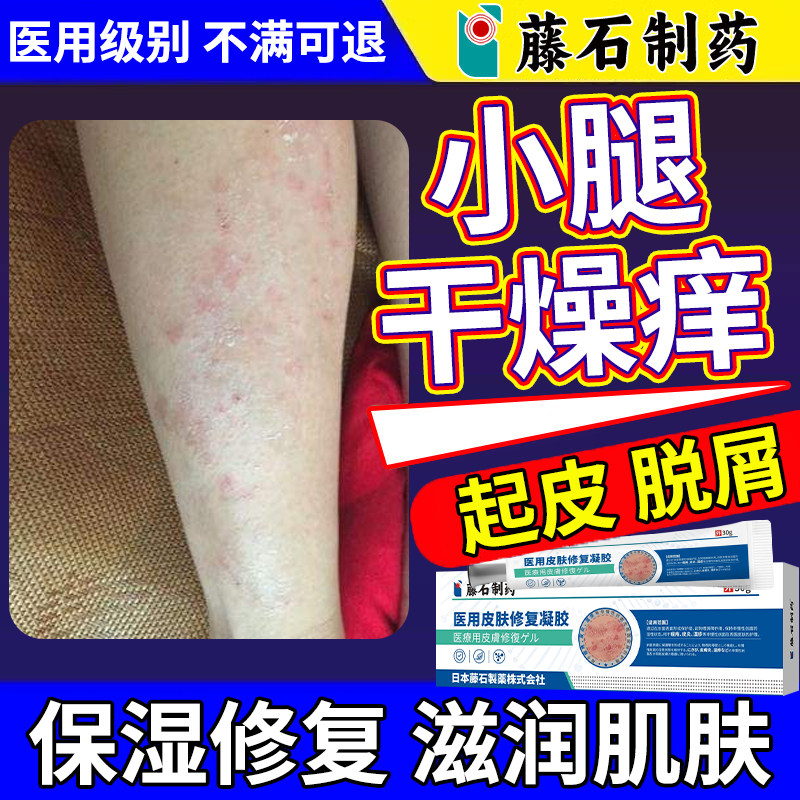 小腿干燥刺痒起皮粗糙鳞屑鱼鳞病秋冬皮肤保湿用专凝胶药房同售YK