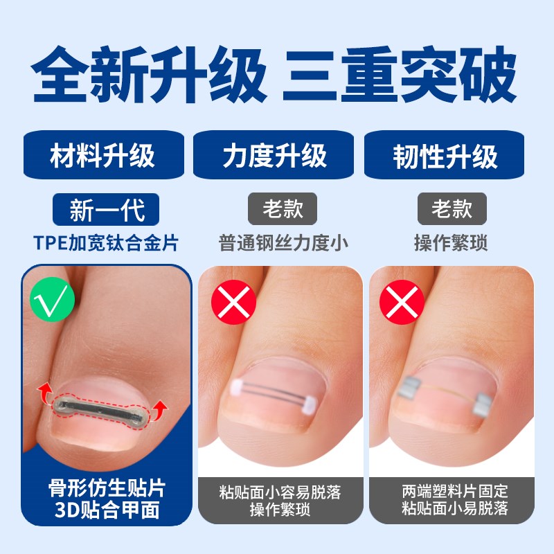 德国钛合金弹片甲沟嵌甲矫正器正甲贴脚趾M指甲往肉里长专用神器