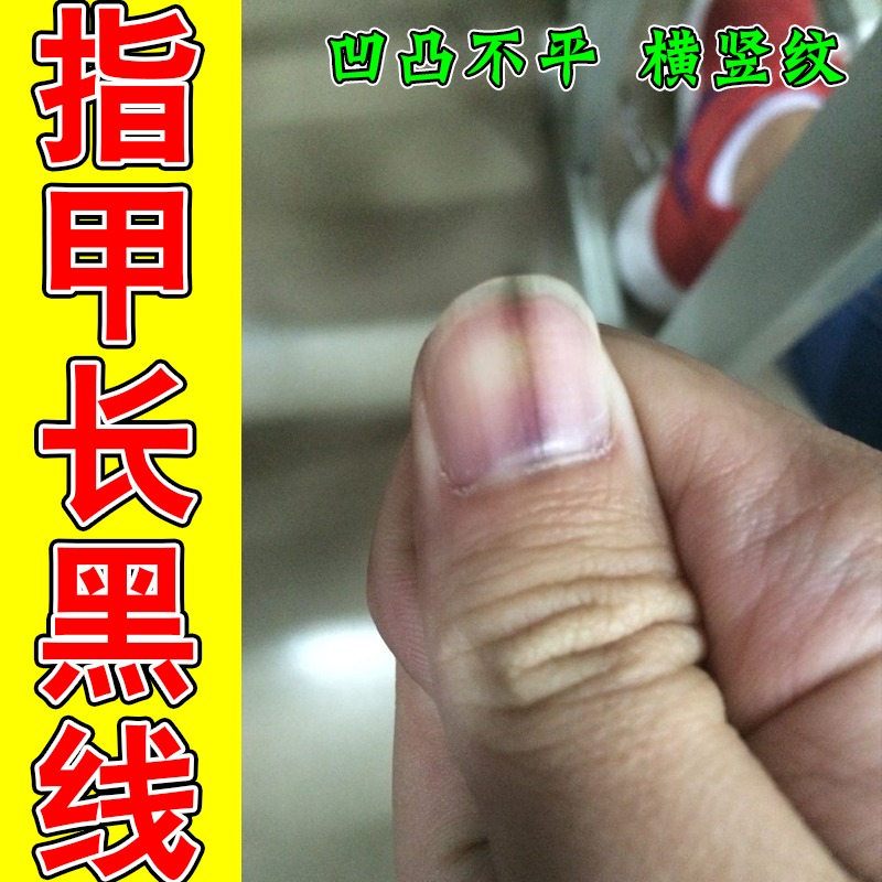 指甲长黑线甲母痣黑指甲专用修复液手脚指甲长黑色竖纹黄甲受损药
