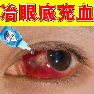 眼底充血眼睛明显异物感灼烧感发痒结膜充血视线模糊畏光黄斑浑浊