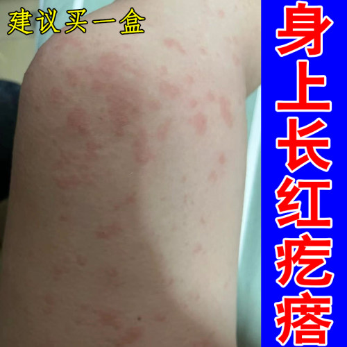身上长红疙瘩玫瑰糠小腿皮肤痒大片红斑红点颈部胳膊疙瘩长痘痘痒
