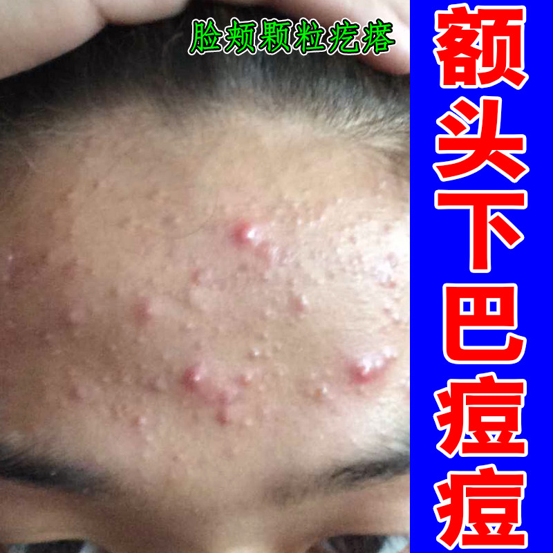 额头下巴痘痘专用膏脸上痘痘闭口粉刺儿童脸上小疙瘩黑头坐疮修复