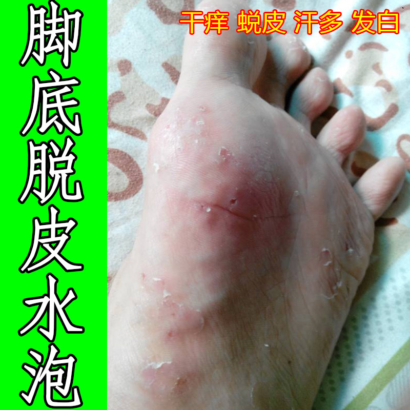 脚底脱皮水泡脚趾缝又痒又脱皮脚鳞屑角化症脚汗脚专用