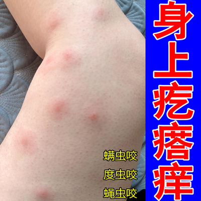 身上疙瘩痒蚊虫叮咬跳蚤咬虫咬性过敏丘疹红肿痘痘床虱疥螨专用膏