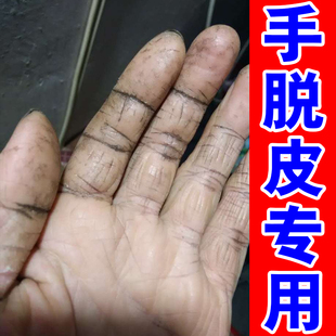 手脱皮专用手干燥粗糙蜕皮剥脱性角质松懈症皮肤裂开修复