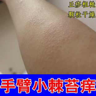 手臂小棘苔痒皮肤干燥粗糙掉屑毛周角化症身上干痒专用修复药