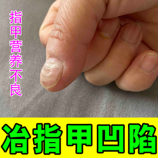 甲床修复生长液指甲受损凹凸不平坑洼甲床分离专用修复药