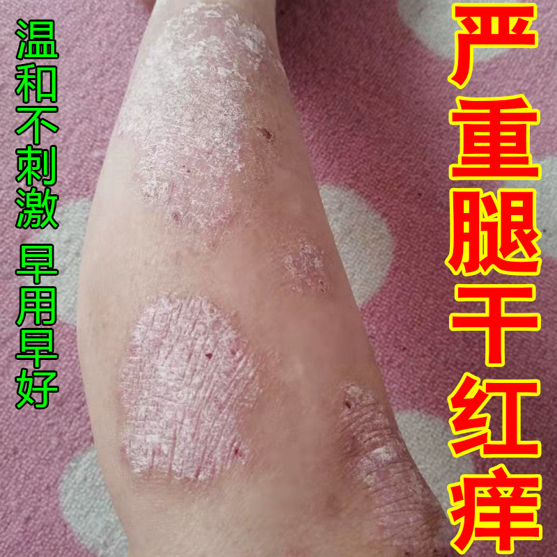严重腿干红痒身上长小红疙瘩掉屑痒神经性过敏痒小腿圆斑脱皮修护
