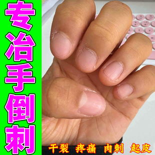 修复手指倒刺指甲边缘干燥起硬皮肉刺手上干裂脱皮去死皮专用修复
