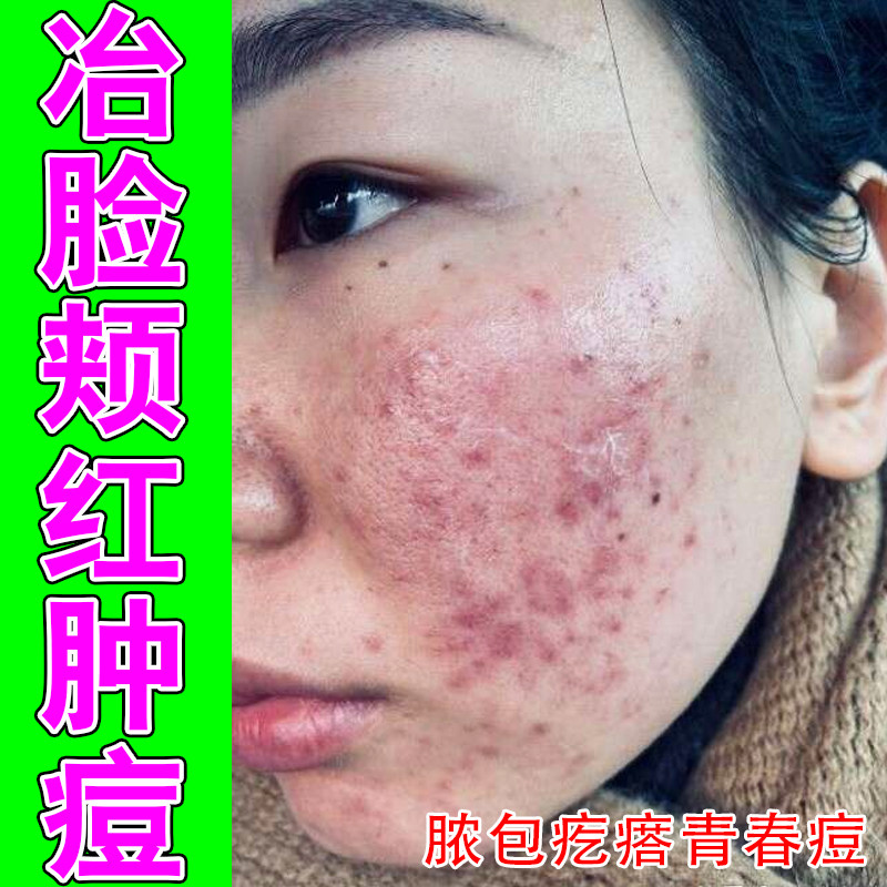 冶脸颊红肿痘逆光闭口粉刺儿童脸上小颗粒男女青春痘换季过敏上火