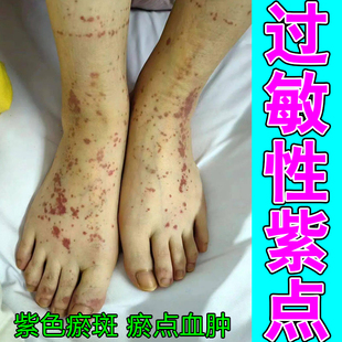 紫点专用膏四肢皮下出血血斑老年皮肤干燥粗糙痒瘀斑冶腿上长红点