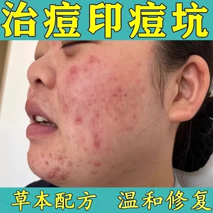 治脸上长痘痘膏修复痘印痘坑脸上痤疮毛囊炎额头小疙瘩粉刺闭口药