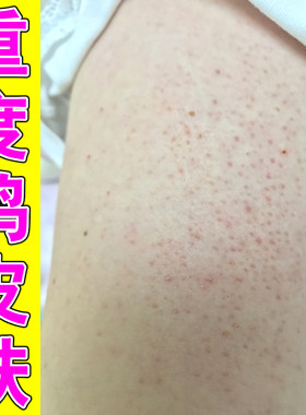 去除胳膊腿上黑点角质毛孔堵塞专用手臂鸡皮疙瘩毛囊毛周角化