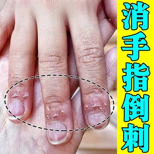 手指倒刺营养油修复神器儿童指甲边缘有肉刺干裂起皮防倒刺护手霜