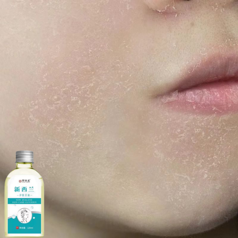 脸上起皮干皮掉皮脸干痒发红刺痛秋冬季面部干燥起干皮皮肤干脱皮