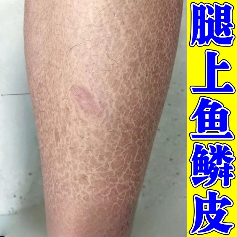 腿上干燥起皮屑鱼鳞病皮肤霜小腿皮肤消毒护理（消）