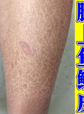 腿上干燥起皮屑鱼鳞病皮肤霜小腿痒粗糙掉皮去鸡蛇皮肤保湿身体乳