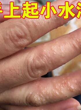 手指起水泡痒药手上长小水泡脱皮干裂出汗痒手背小疙瘩外用修复膏