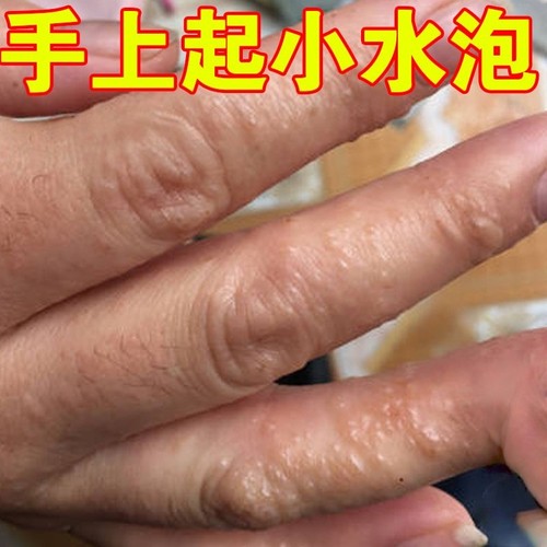 手指起水泡痒药手上长小水泡脱皮干裂出汗痒手背小疙瘩外用修复膏