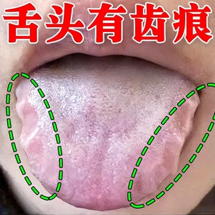 舌头裂纹有齿痕舌苔发白厚腻口臭调理舌边缘锯齿状灼口综合征喷剂