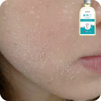 脸部干皮脸干起皮脸上起皮脱皮脸干痒爆皮季节性皮肤干燥粗糙滋润