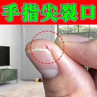 手指尖裂口子干裂脱皮冬天指甲缝开裂干燥粗糙修复霜治手裂的药膏