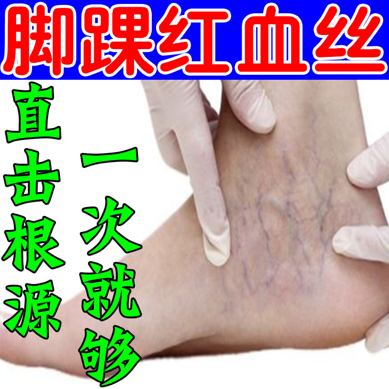 精索静脉曲张腿上有红血丝脚踝血护具（器械）