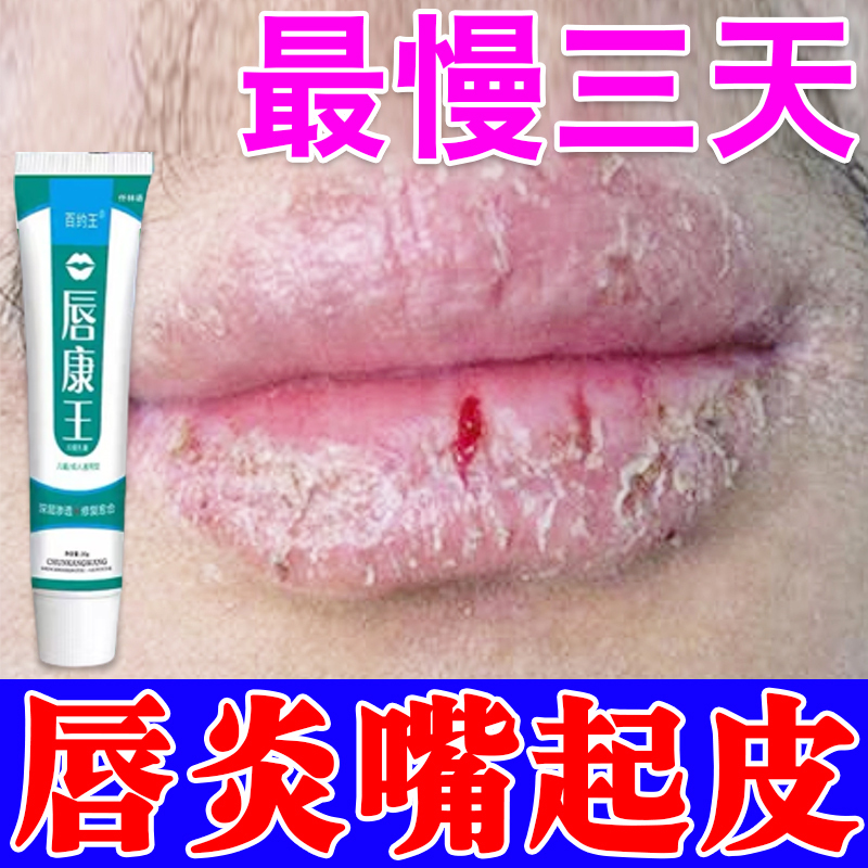 冬天嘴巴干燥起皮保湿补水润唇膏治唇炎烂嘴角裂口红肿疼痛脱皮痒