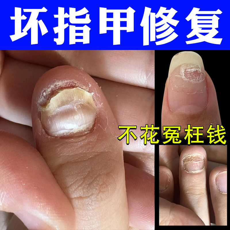 指甲快速生长液甲床受损分离啃咬变硬增厚空护甲坏甲修复油营养液