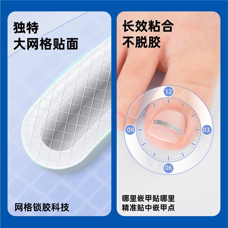 曲平甲沟嵌甲指甲矫正器正甲贴片脚趾甲盖卷甲内R嵌神器固定足科