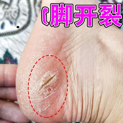 脚后跟干裂起硬皮足跟开裂感染真菌修复霜脚底增厚干裂粗糙修护膏