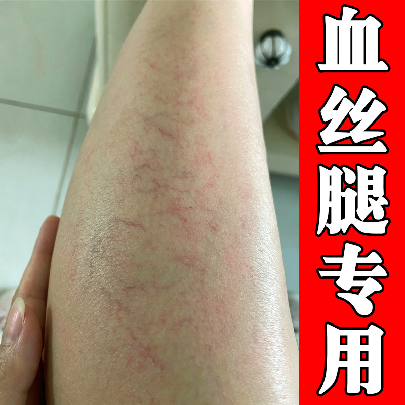血丝腿专用毛细血管扩张腿上有红血丝青筋凸起修复软膏