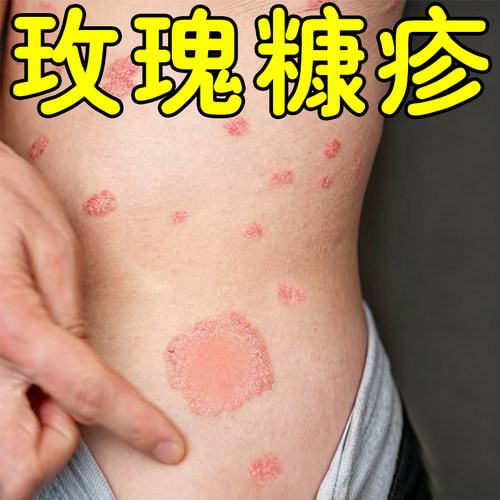 玫瑰糠疹专用身上长红斑干燥粗糙起皮掉屑皮肤鳞屑干痒外用修复药
