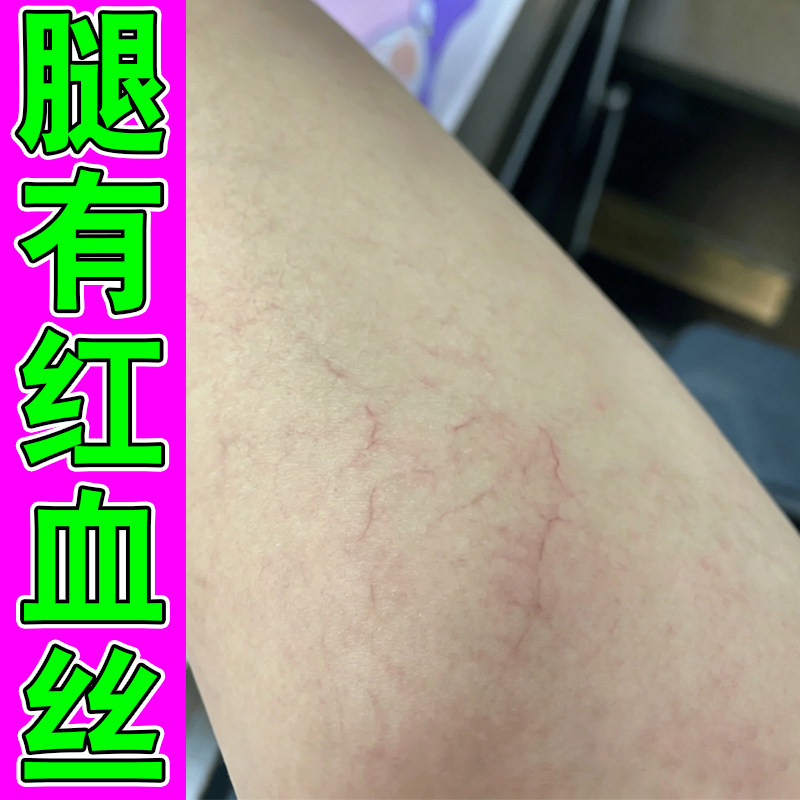 腿上有红血丝男女性腿部青筋凸起药修复毛细血管扩张软膏