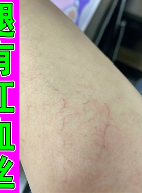 腿上有红血丝男女性腿部青筋凸起药修复毛细血管扩张软膏