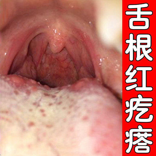 舌根红疙瘩小红点舌苔白厚腻舌部两侧凸起小肉球
