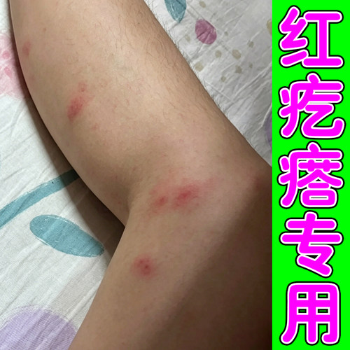 蚊虫叮咬红疙瘩专用腿上小腿皮肤痒臭虫跳蚤叮咬红点疙瘩