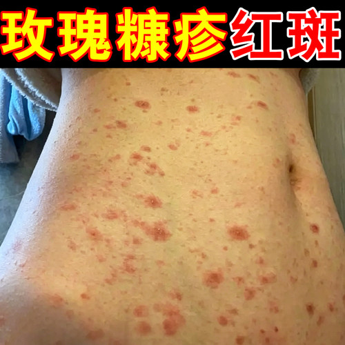 玫瑰糠疹红斑干燥粗糙起皮掉屑皮肤痒身上过敏长红斑鳞屑蜕皮外用