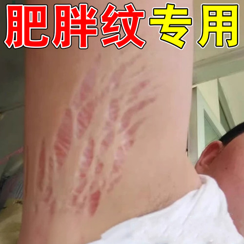 去肥胖纹修复霜生长纹消大腿学生腰腹上肥胖纹除纹路男女通用软膏